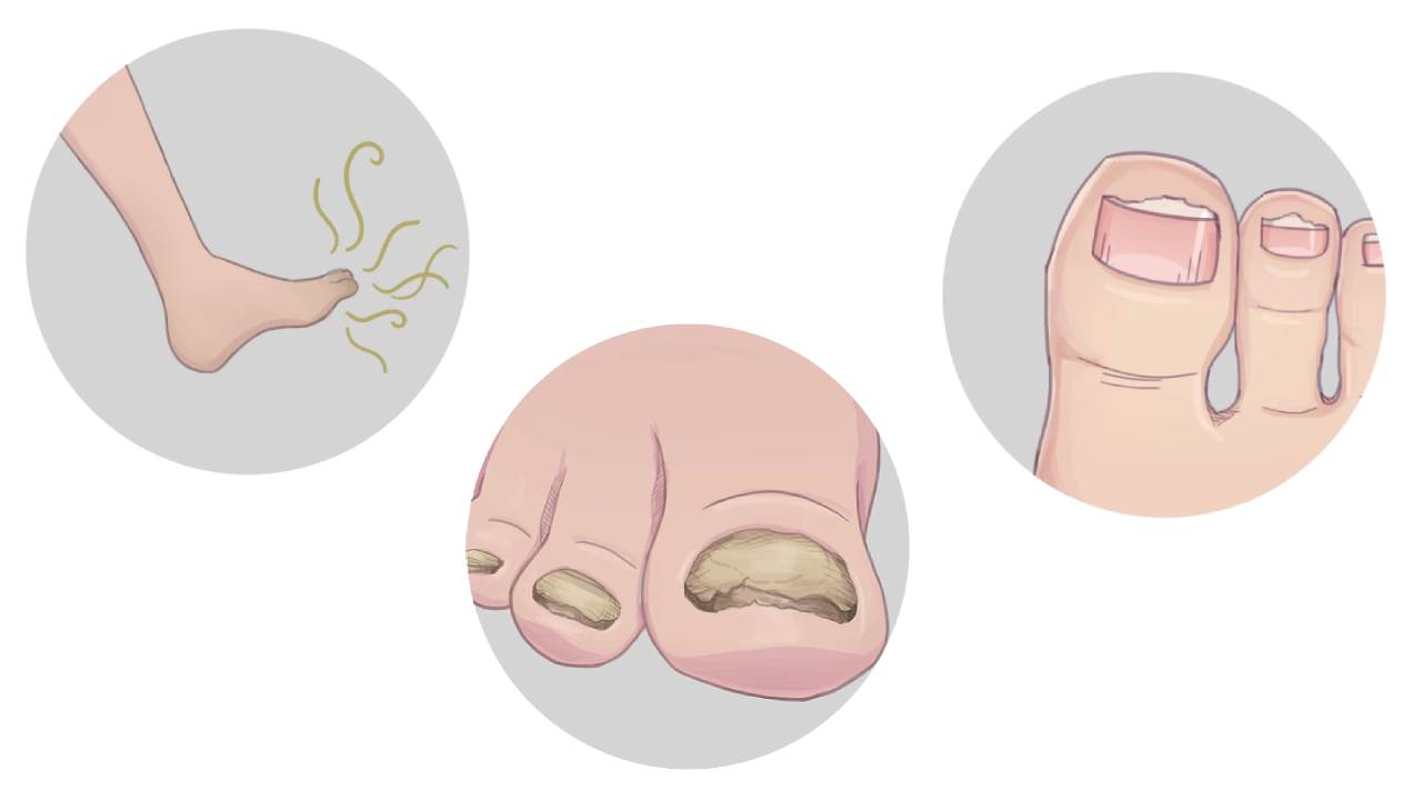 What Are the Signs and Symptoms of Nail Fungus?